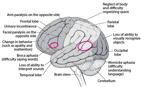 Aphasia - Aphasia - MSD Manual Consumer Version