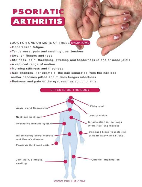 Psoriatic arthritis affects and symptoms | Psoriasis arthritis ...