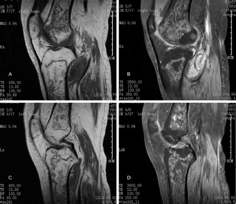 Image result for Exploding Massive Knee Abscess
