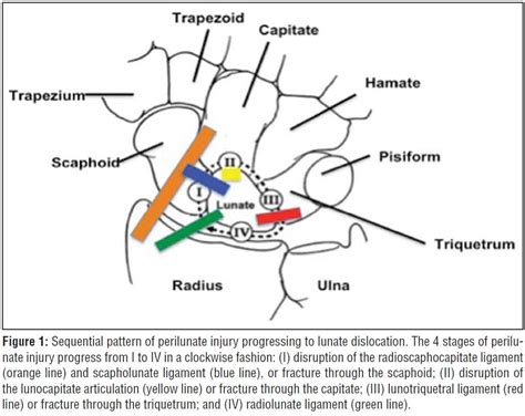 Image result for Lunate Dislocation Reduction