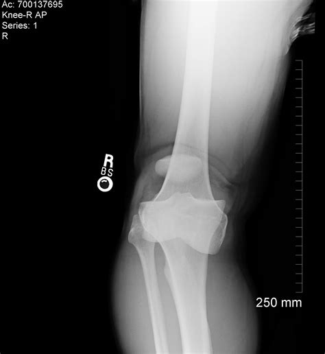 Sternoclavicular Dislocation Trauma Orthobullets