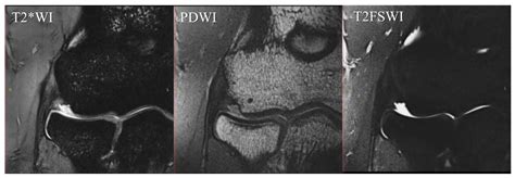 Individual Evaluation of the Common Extensor Tendon and Lateral ...