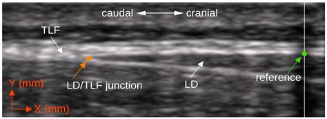 Associations between Deformation of the Thoracolumbar Fascia and ...
