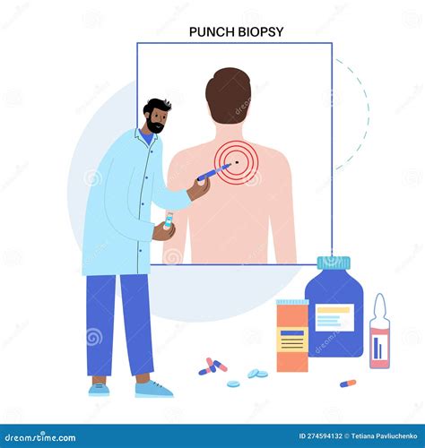 Punch biopsy procedure stock illustration. Illustration of treatment ...