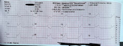 79 YOM. Substernal chest pain. : r/EKGs