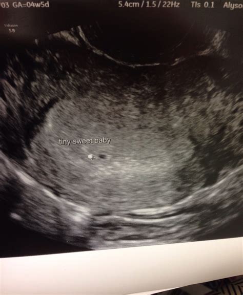 4 Week Ultrasound Pictures
