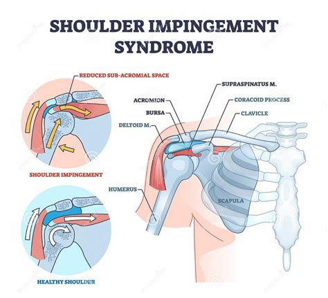 Shoulder Impingement Syndrome - MEDizzy