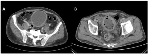 Clinical Outcomes and Risk Factor Analysis of Patients Presenting with ...