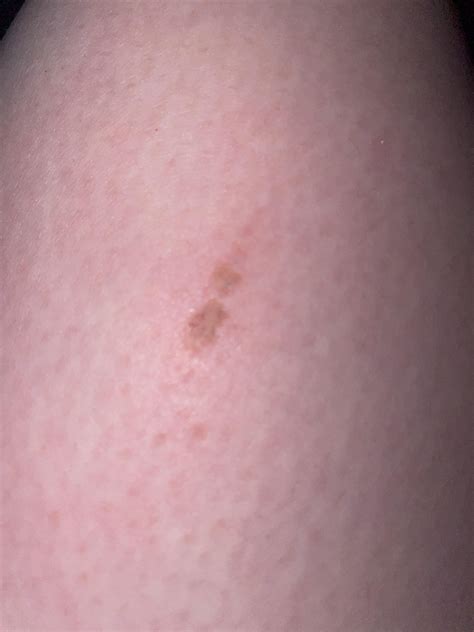 Will these small eraser/friction burns scar? : r/scars