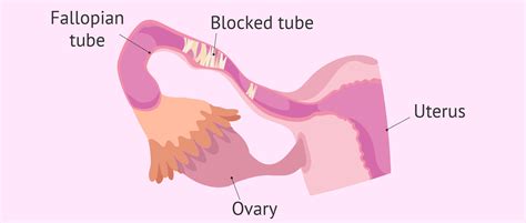 Image result for Fallopian Tube Blockage Surgery