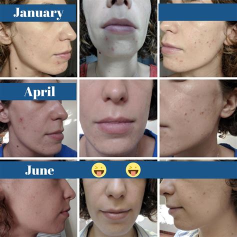 Retinol Jawline Acne at Nicholas Michael blog