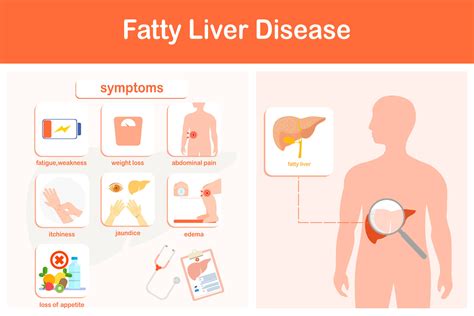 Vector illustration. Infographic of fatty liver disease. Weakness ...