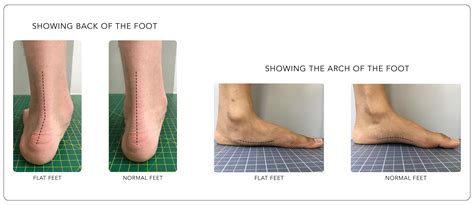 Foot Talk Fridays : Flat Feet | Dubai Podiatry Centre