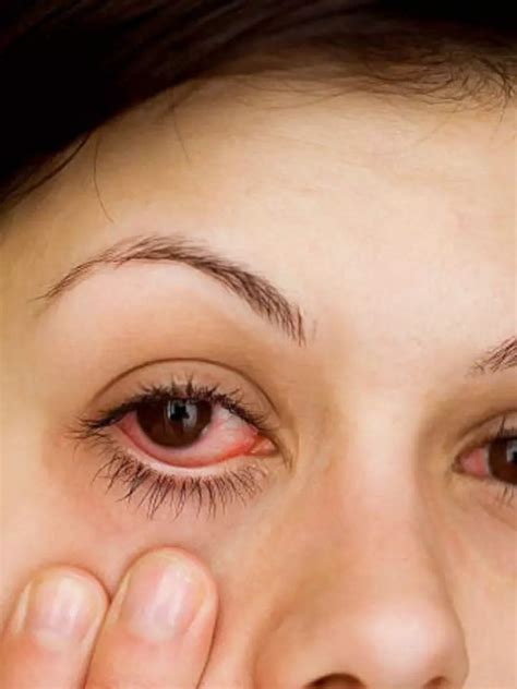 Home Remedies To Cure Conjunctivitis | Times Now