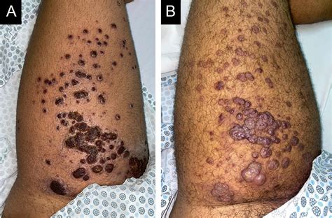 Kaposi Sarcoma Pictures