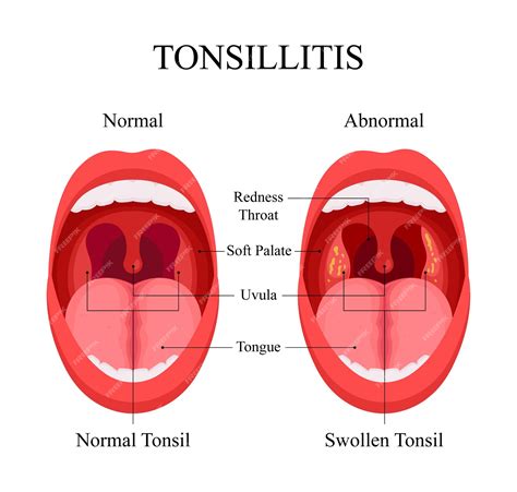 Diagram of tonsillitis causes normal tonsils and swollen tonsils | Premium Vector
