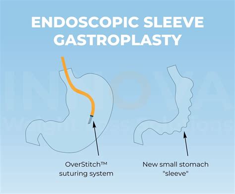 OverStitch Endoscopic Sleeve Gastroplasty – Innova Weight Loss Solutions