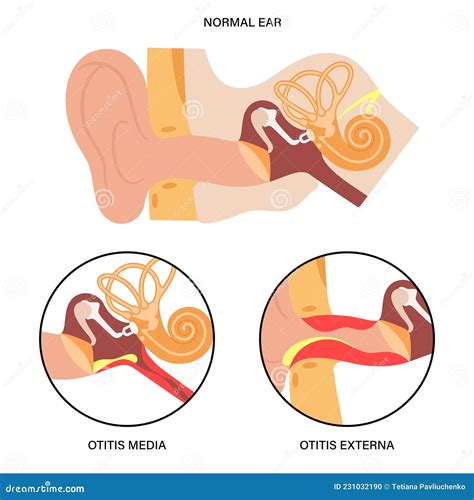 Otitis. Healthy Membrane, And Bulging Tympanic Membrane Of Acute Otitis Media Vector ...