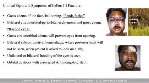 Midface fracture.pptx