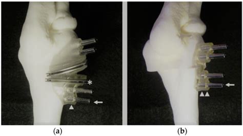 An Innovative and Cost-Advantage CAD Solution for Cubitus Varus ...
