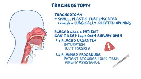 Image result for Trach Procedure