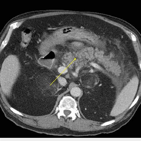 Image result for CT Scan with Contrast
