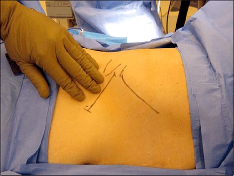 Image result for Flank Incision Nephrectomy