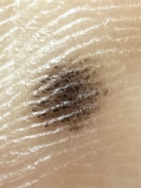 Mole on foot sole : r/Melanoma