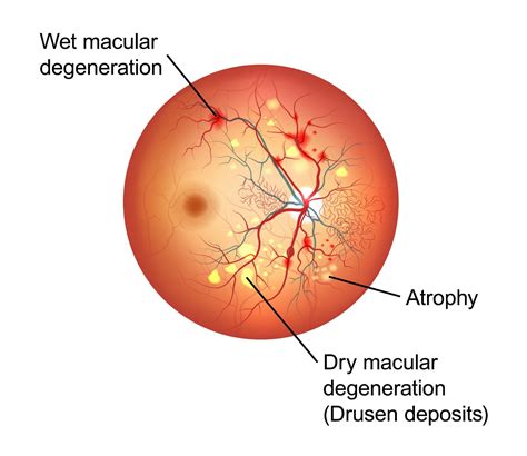 Macular Degeneration Test Grid at Jean Nelson blog