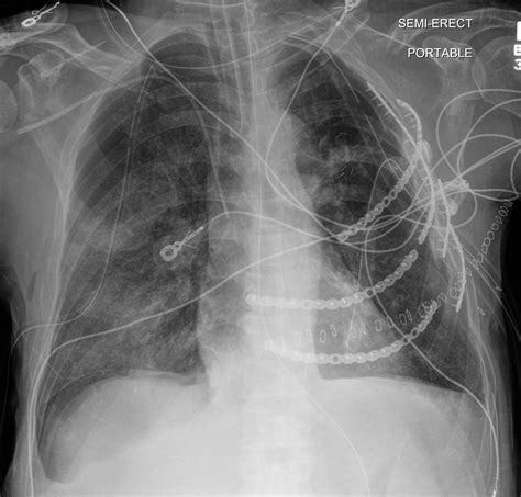 Image result for Sulcus Sign Grading