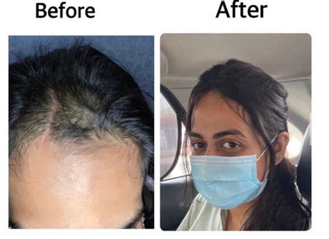 Why Scalp topper is necessary – HAIR YOU GO INDIA