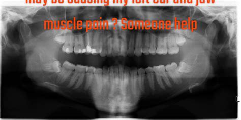 Help someone need advice tmj ear pain please left ear pain and left jaw pain muscle hurts bad ...