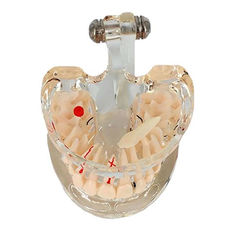 Dental Implant Disease Teeth Model With Restoration Bridge Tooth – UNIQBUY