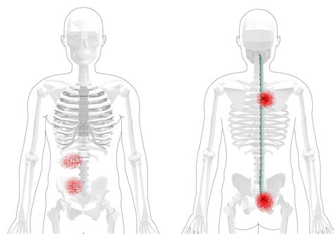 Upper Back Trigger Points (Overview + Tips and Exercises)