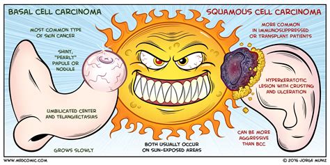 Basal Cell Carcinoma Vs Squamous Cell Carcinoma Appearance at Kurt Scott blog