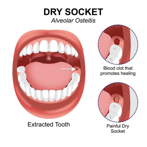 What is Dry Socket? A Complete Guide | Rock Family Dental
