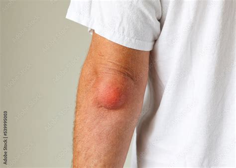 Image result for Elbow Cysts Explode