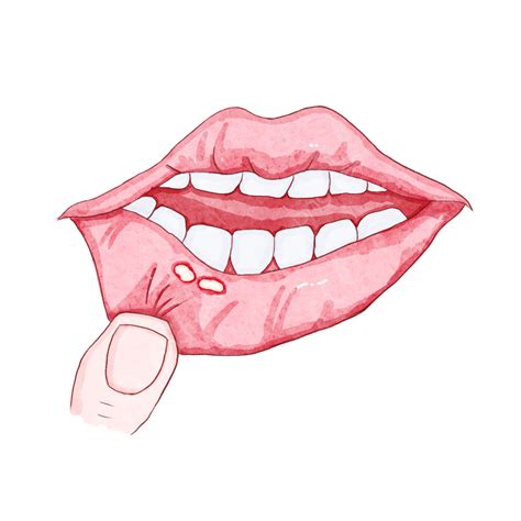 Oral Ulcers Oral Problems Oral Health, Mouth Ulcer, Oral Problems, Oral Health PNG Transparent ...