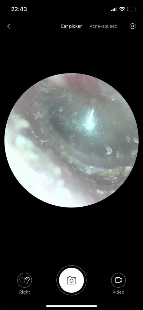 This came out of my right ear!! I used an ear drop about 4 days ago, but got anxious as soon as ...