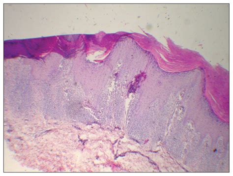Diagnosis: Hypertrophic lichen planus | Annals of Saudi Medicine