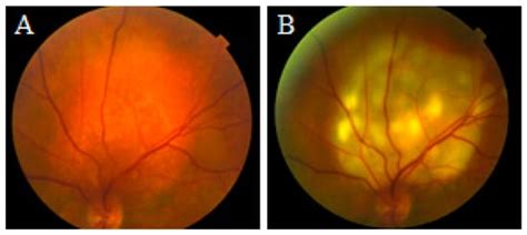 Laser Indirect Ophthalmoscopy-Guided Transpupillary Thermotherapy ...