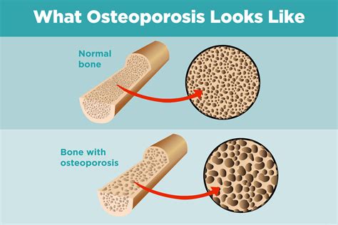 Cara Mengobati Osteoporosis - Varash
