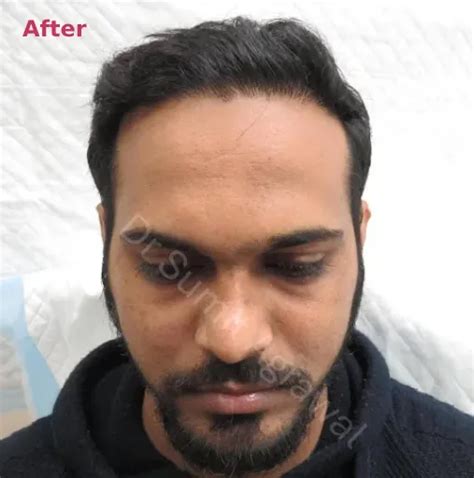 Hair Graft Calculator