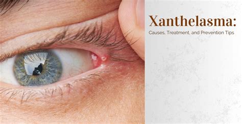 Xanthelasma: Causes, Treatment, and Prevention Tips | Clinikally