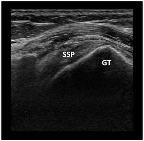 The Current Role of Collagen Patch Augmentation in Rotator Cuff ...