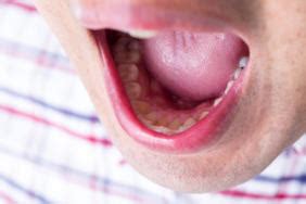 舌の病気や種類について解説!こんな症状がある場合は要注意 | 歯のアンテナ
