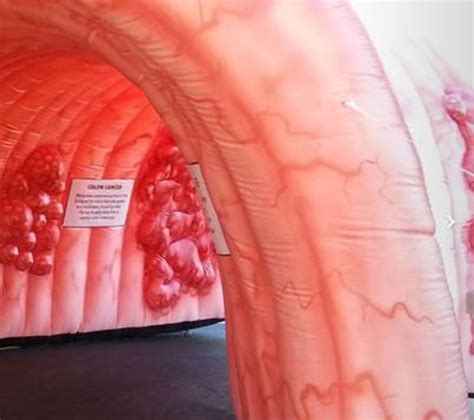 Owensboro Health uses inflatable colon to help raise awareness to colon ...