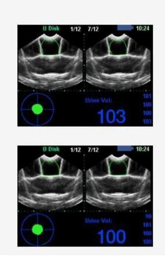 Bladder Scanner - Portable Bladder Scanner Manufacturer from Pune