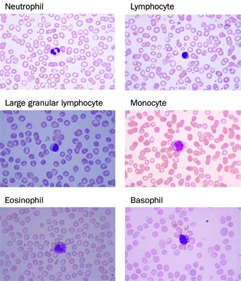 White blood cells 1: non-malignant disorders - The Lancet