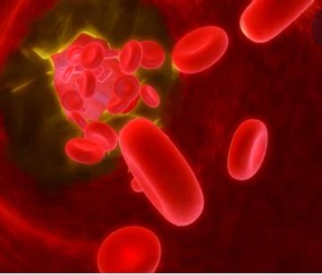 एओर्टिक कैल्सीफिकेशन क्या है, जानिए इसके बारे में अधिक जानकारी - हैलो ...